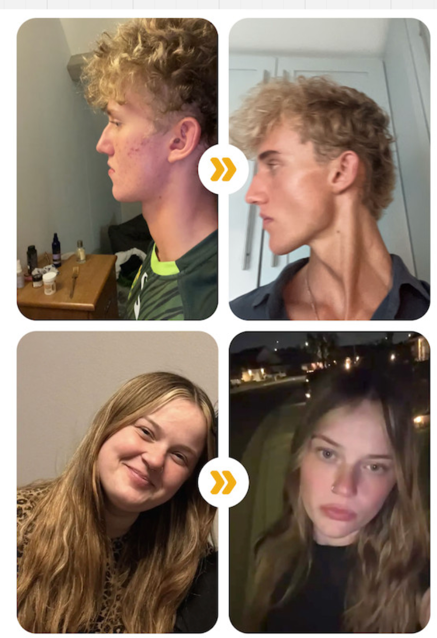 Avant après SKIN+